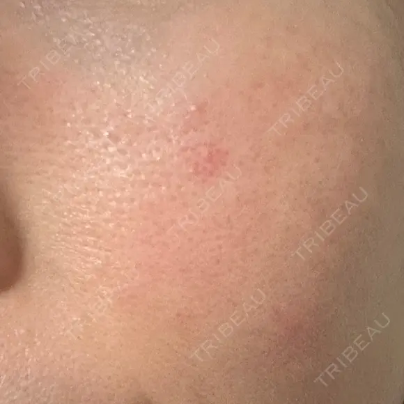 その他（肌） YAYOI CLINIC DAY 3 メイン用