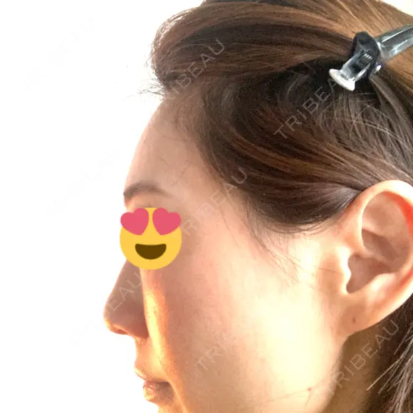 脂肪注入（肌） / こめかみ形成 / 脂肪注入（額） / 脂肪注入（輪郭） Mods Clinic（モッズクリニック） 福岡院 AFTER メイン用