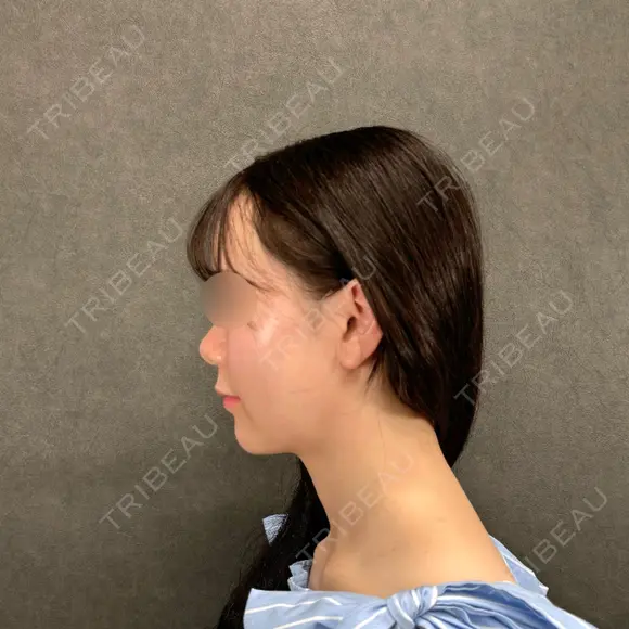 糸リフト / 脂肪吸引（顔） ネビュラクリニック 京都院 DAY 0 メイン用