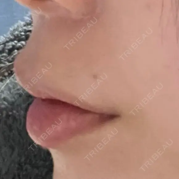 ボトックス（あご） / ボトックス（口角） / ボトックス（タレ目） / ボトックス（人中） LA CLEF CLINIC（ラクレクリニック） AFTER メイン用