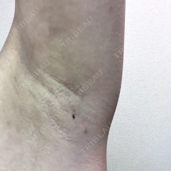ワキ汗治療（レーザー） Fellez Clinic【フェルズクリニック】 DAY 31 メイン用