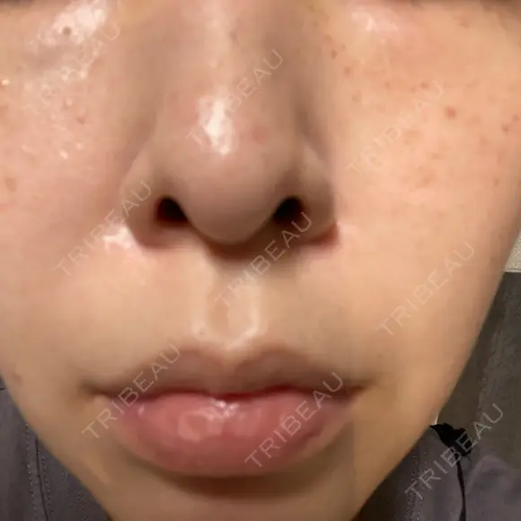 エレクトロポレーション / 光治療（フォトフェイシャルなど） / ルメッカ ゆきスキンクリニック 東池袋 DAY 1 メイン用