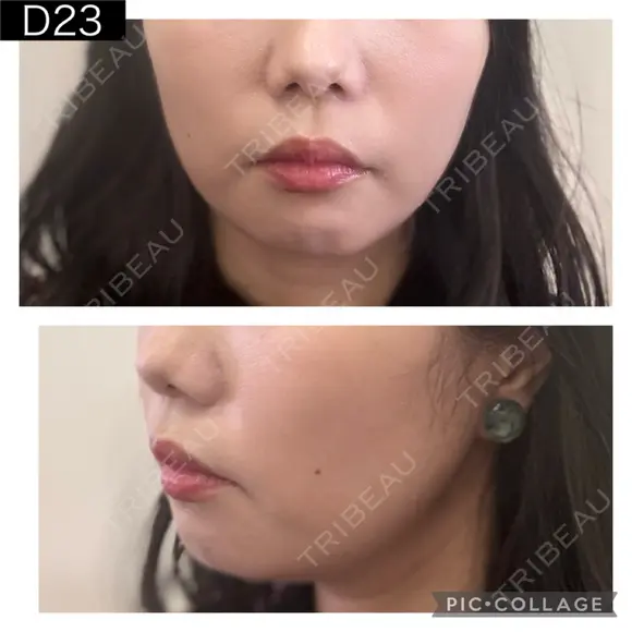 糸リフト PRISM Beauty Clinic 町田院 DAY 23 メイン用