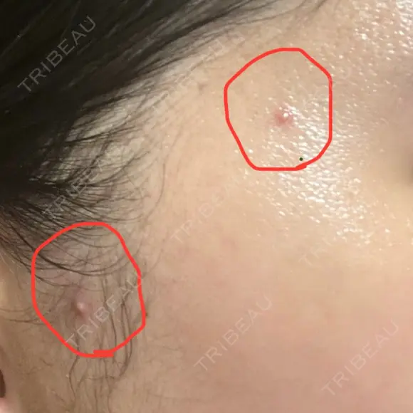 糸リフト PRISM Beauty Clinic 町田院 DAY 26 メイン用