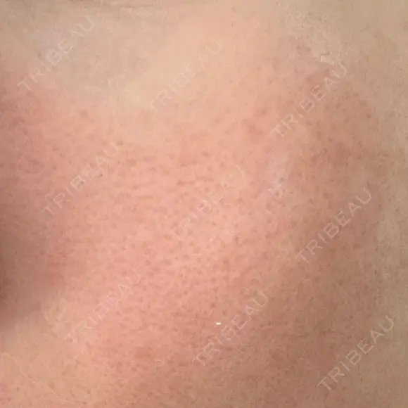 その他（肌） YAYOI CLINIC DAY 9 メイン用