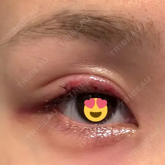 その他（目元） グリシーヌクリニック DAY 2 メイン用