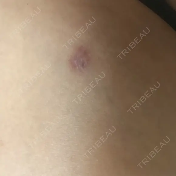 脂肪吸引（脚） / 脂肪吸引（お尻） ドクターフィット（Dr.fit）クリニック DAY 55 メイン用