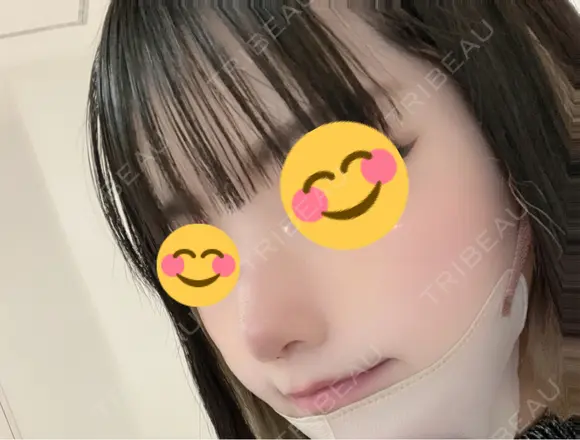 鼻尖形成（切開） / 鼻中隔延長（切開） / 軟骨移植 / ワシ鼻修正・ハンプ切除 / 鼻修正 R Beauty CLINIC 銀座院 DAY 7 メイン用
