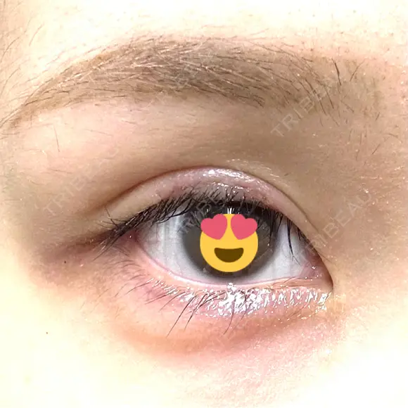 その他（目元） グリシーヌクリニック DAY 7 メイン用