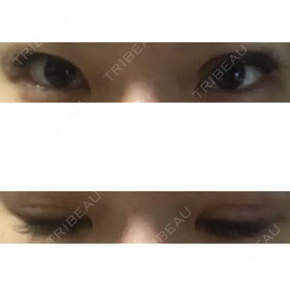 眼瞼下垂（切開） ピュア形成外科医院 DAY 40 メイン用