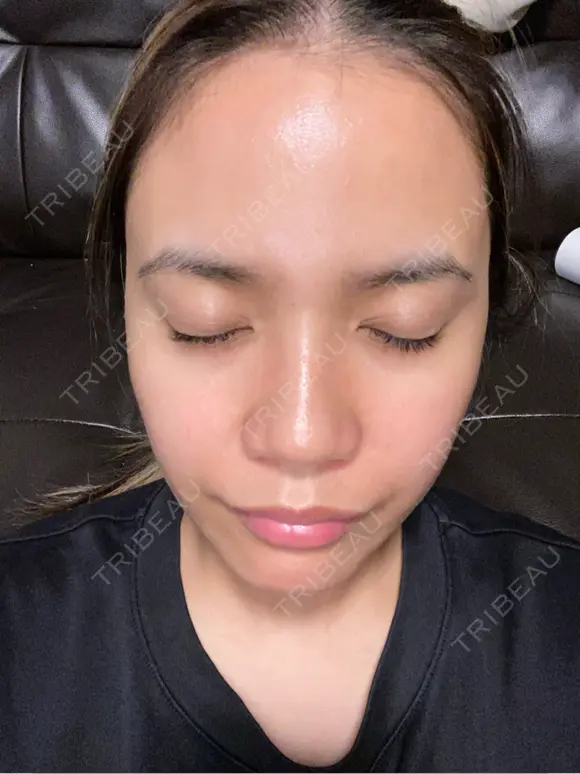 水光注射（ハリ・美肌） 小木曽クリニック AFTER メイン用