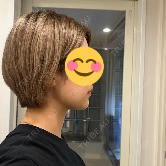 脂肪吸引（顔） お茶の水美容形成クリニック DAY 40 メイン用