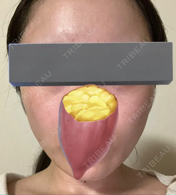 その他（肌） / ピーリング（ハリ・ツヤ） 東京シンデレラ美容外科 大宮院 DAY 3 メイン用