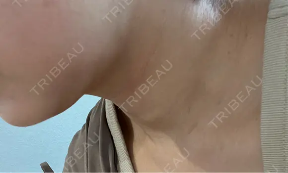 脂肪吸引注射（顔） 湘南美容クリニック 仙台院 DAY 21 メイン用