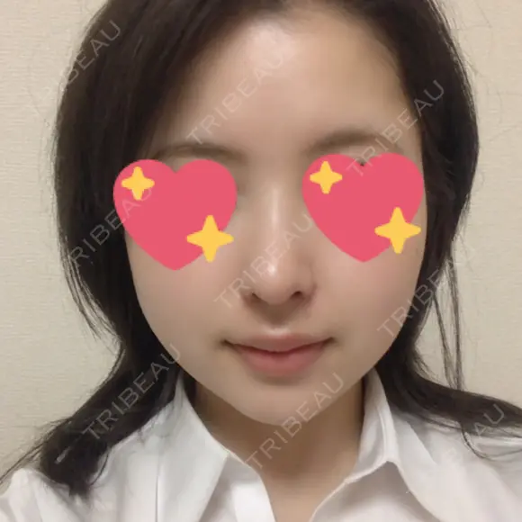 鼻尖形成（切開） / 鼻中隔延長（切開） / 小鼻縮小（切開） / 軟骨移植 / 鼻尖縮小 HANABI整形外科 DAY 20 メイン用