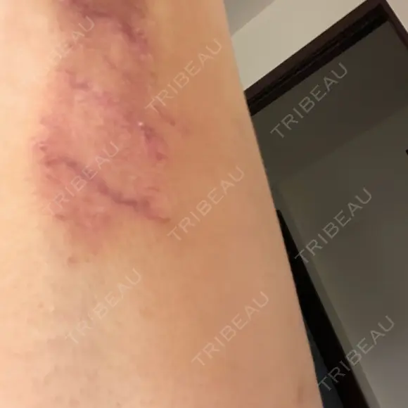 ワキ汗治療（切開） 石倉クリニック 水戸院 DAY 94 メイン用