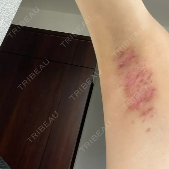 ワキ汗治療（切開） 石倉クリニック 水戸院 DAY 94 メイン用