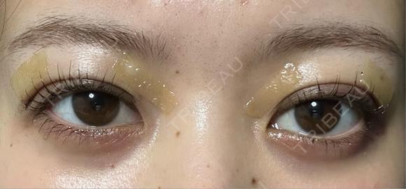 自然癒着法 / 眼瞼下垂（非切開） LUHO（ルホ）美容外科 DAY 3 メイン用