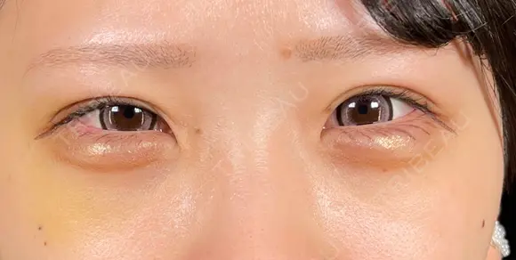 クマ治療 R Beauty CLINIC 銀座院 DAY 7 メイン用