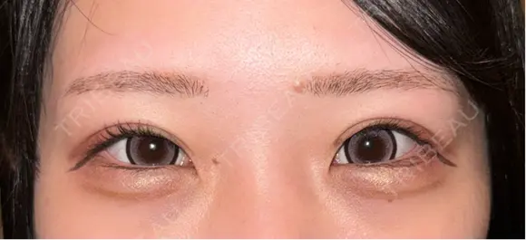 クマ治療 R Beauty CLINIC 銀座院 AFTER メイン用