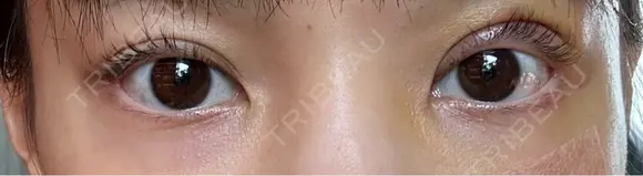 二重切開 WOM CLINIC GINZA （ワム クリニック ギンザ） DAY 5 メイン用