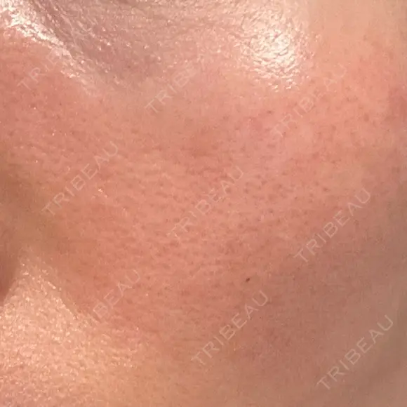 その他（肌） YAYOI CLINIC DAY 4 メイン用