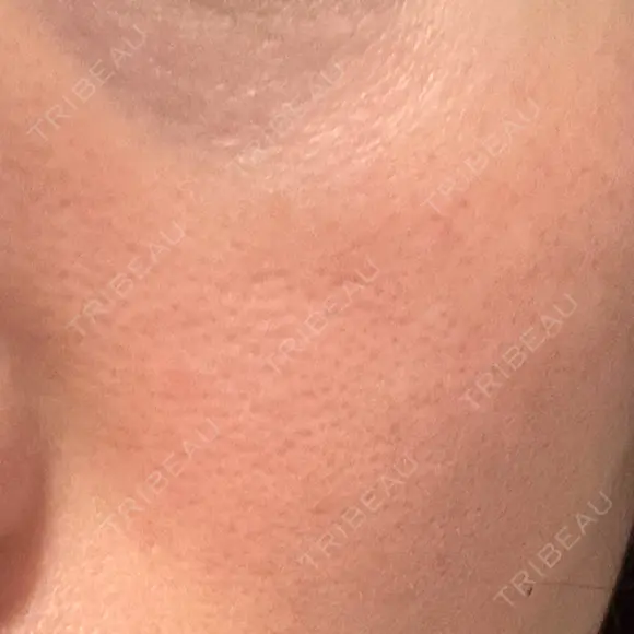 その他（肌） YAYOI CLINIC DAY 6 メイン用