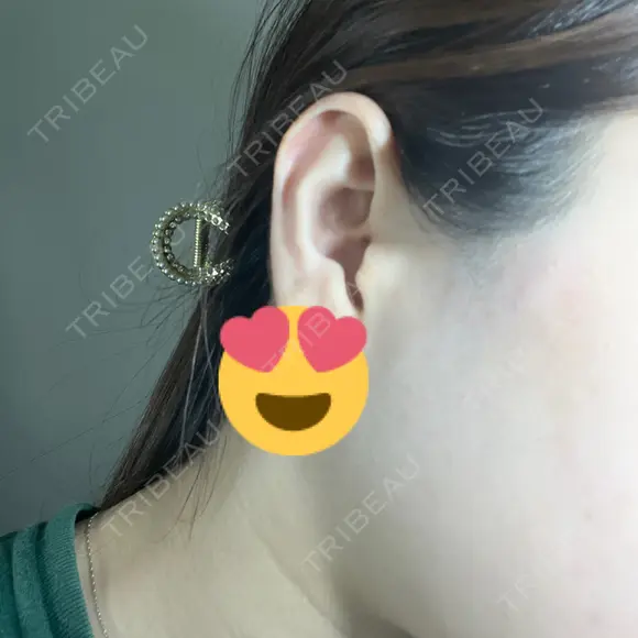 医療脱毛（顔） Lumiera Clinic AFTER メイン用