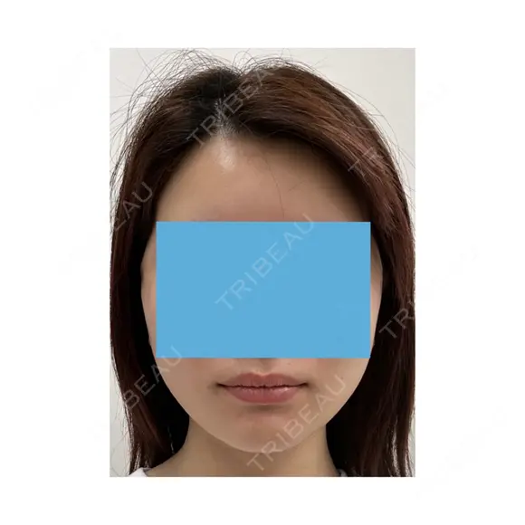 切開リフト 東京エビスクリニック AFTER メイン用