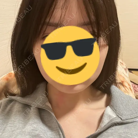 ボトックス（エラ・小顔） 共立美容外科 大阪本院 AFTER メイン用