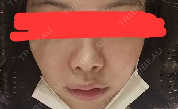ボトックス（首） / ヒアルロン酸注入（鼻翼基部） KAGA CLINIC AFTER メイン用