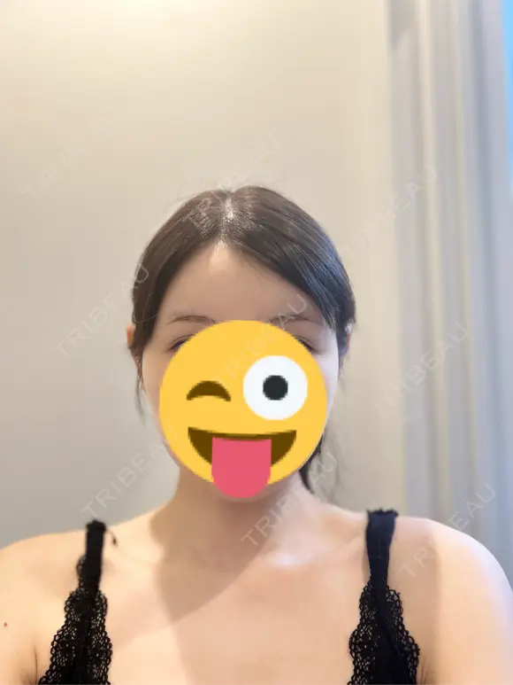 額を丸く / 脂肪吸引（二の腕） / こめかみ形成 / 脂肪注入（額） / 脂肪吸引（肩） / 脂肪注入（輪郭） Mods Clinic（モッズクリニック） 名古屋院 DAY 30 メイン用