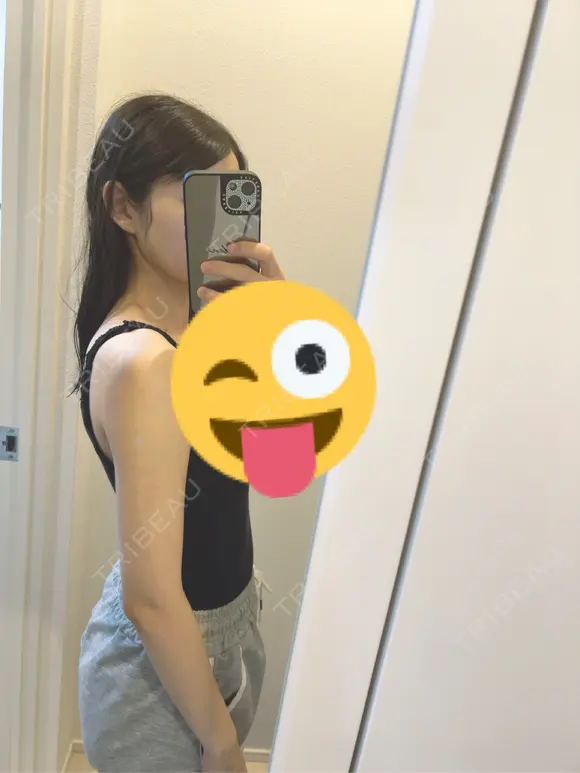 額を丸く / 脂肪吸引（二の腕） / こめかみ形成 / 脂肪注入（額） / 脂肪吸引（肩） / 脂肪注入（輪郭） Mods Clinic（モッズクリニック） 名古屋院 DAY 30 メイン用
