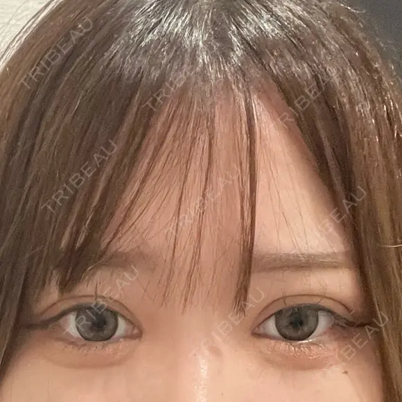 二重埋没 / 目頭切開 / 糸リフト / 脂肪吸引（顔） / ヒアルロン酸注入（涙袋） R Beauty CLINIC 名古屋院 DAY 92 メイン用