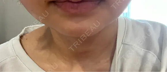 脂肪吸引注射（顔） 湘南美容クリニック 仙台院 AFTER メイン用