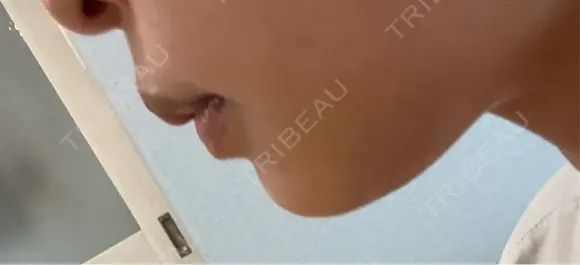 脂肪吸引注射（顔） 湘南美容クリニック 仙台院 DAY 28 メイン用