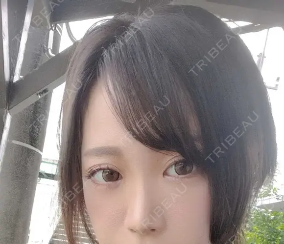 クマ治療 / 下まぶたたるみ取り / ボトックス（あご） / ヒアルロン酸注入（あご） / ヒアルロン酸注入（目の下） / ヒアルロン酸注入（鼻翼基部） / スネコス Tokyo Tensei Clinic 新宿院 DAY 15 メイン用