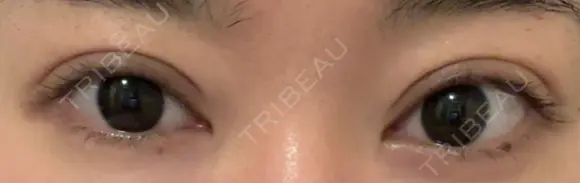 二重埋没 Brandnew Beauty Clinic DAY 1 メイン用