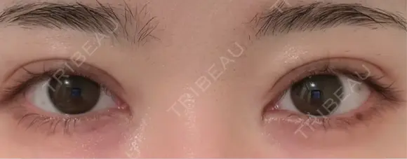 二重埋没 Brandnew Beauty Clinic DAY 2 メイン用