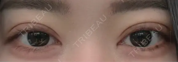 二重埋没 Brandnew Beauty Clinic DAY 3 メイン用