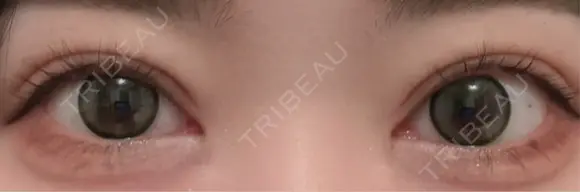 二重埋没 Brandnew Beauty Clinic DAY 4 メイン用