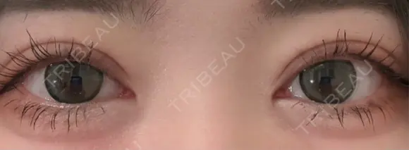 二重埋没 Brandnew Beauty Clinic DAY 5 メイン用