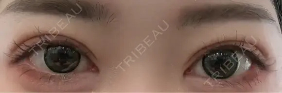 二重埋没 Brandnew Beauty Clinic DAY 7 メイン用