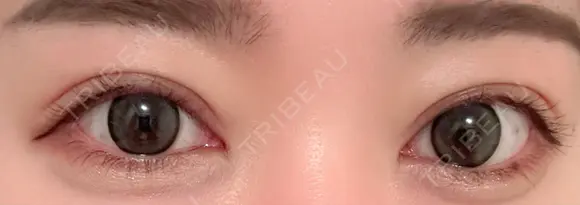 二重埋没 Brandnew Beauty Clinic DAY 11 メイン用