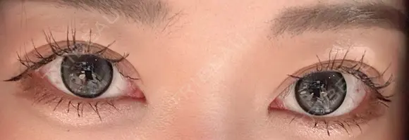 二重埋没 Brandnew Beauty Clinic AFTER メイン用