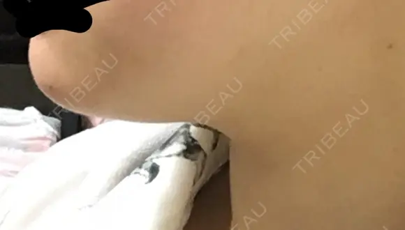 脂肪溶解注射（顔） / PRP皮膚再生療法 聖心美容クリニック 六本木院 DAY 20 メイン用