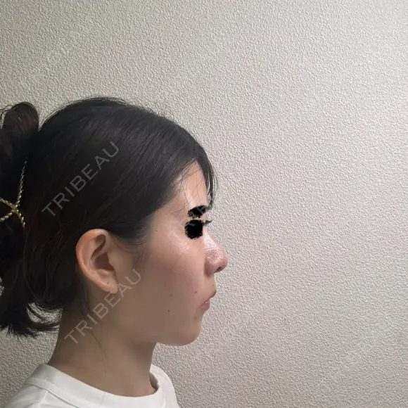 隆鼻術 / 鼻中隔延長（切開） / 鼻翼基部形成（貴族手術） ヴェリテクリニック 銀座院 DAY 264 メイン用