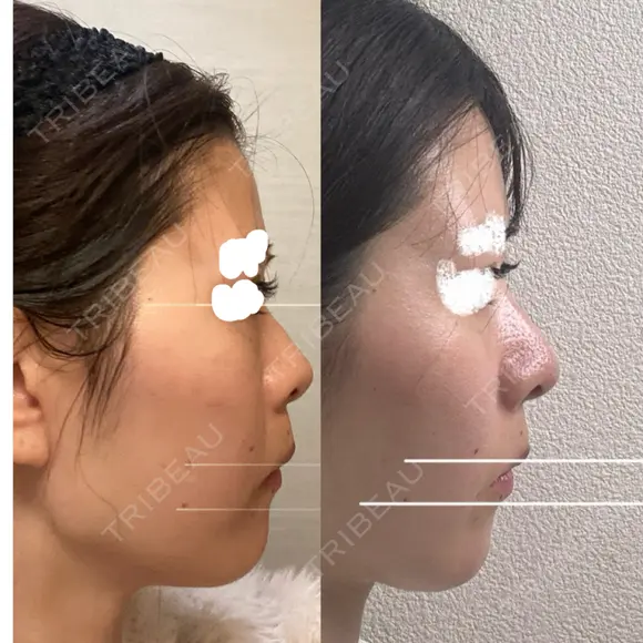 隆鼻術 / 鼻中隔延長（切開） / 鼻翼基部形成（貴族手術） ヴェリテクリニック 銀座院 AFTER メイン用