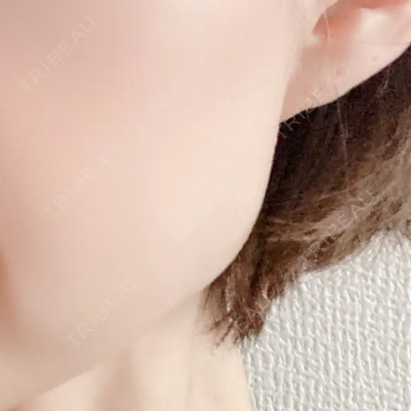 ボトックス（エラ・小顔） 共立美容外科 梅田院 DAY 0 メイン用