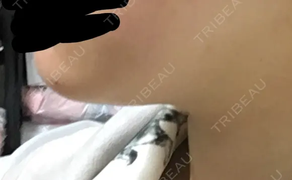 脂肪溶解注射（顔） / PRP皮膚再生療法 聖心美容クリニック 六本木院 DAY 20 メイン用